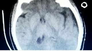 جراحة دقيقة وخطيرة تجري لستيني في الطائف